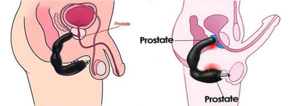 เครื่องนวดต่อมลูกหมาก นวดกระตุ้นจุด P-SPOT สำหรับท่านชาย ช่วยให้อวัยวะเพศชายแข็งตัวดีขึ้น ใช้เพิ่มความสุข สนุกขณะร่วม ทำความสะอาดง่าย ปลอดภัย